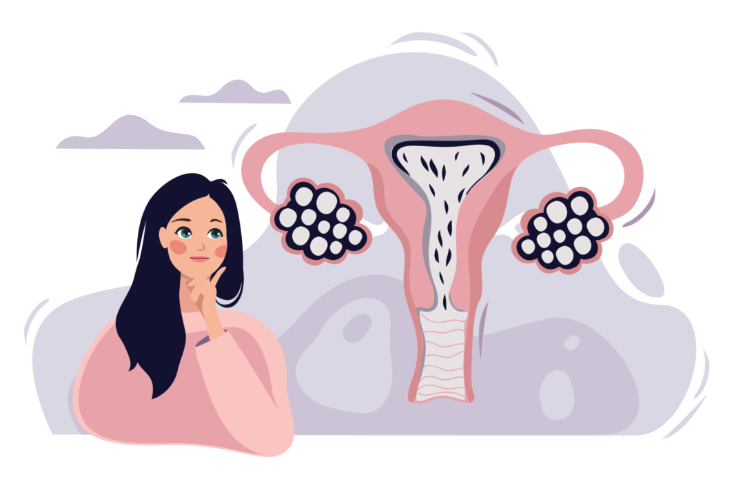 Përfitimet shëndetësore të dietës ketogjenike mbi PCOS (sindroma e ovarit policistik)