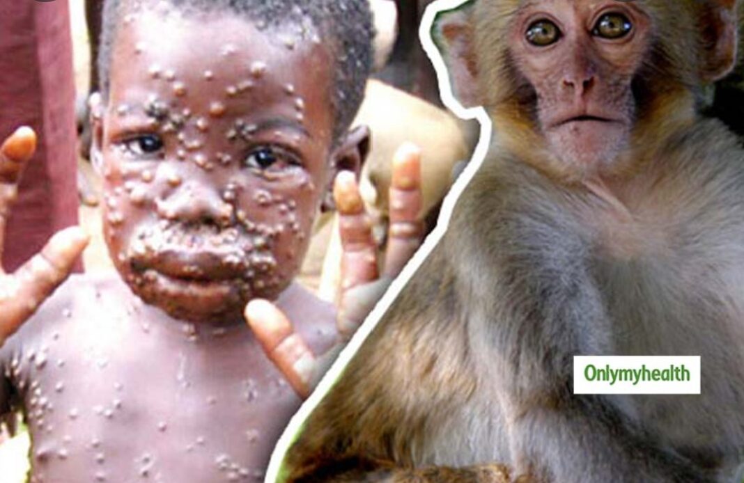 Çfarë është lija e majmunëve, virusi i rrallë i konfirmuar tashmë në SHBA dhe Evropë?