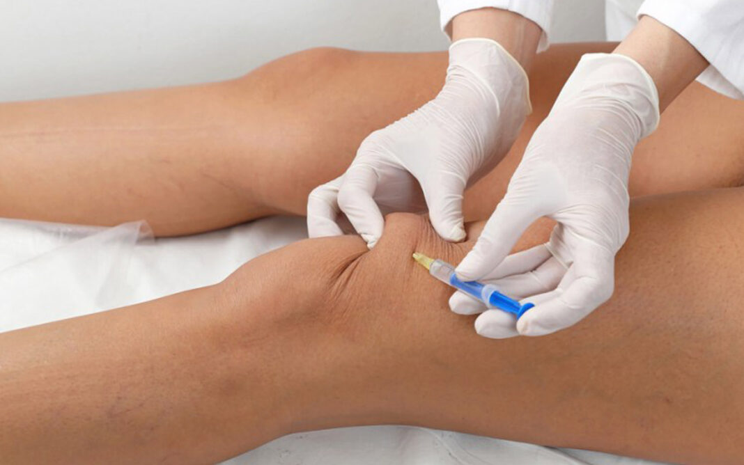 Injeksionet në gju me acid hialuronik ekuivalent me placebo