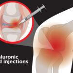 skema e injektimit_Hyaluronic-Acid